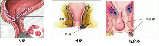 女性痔疮怎么检查 女性痔疮怎么检查